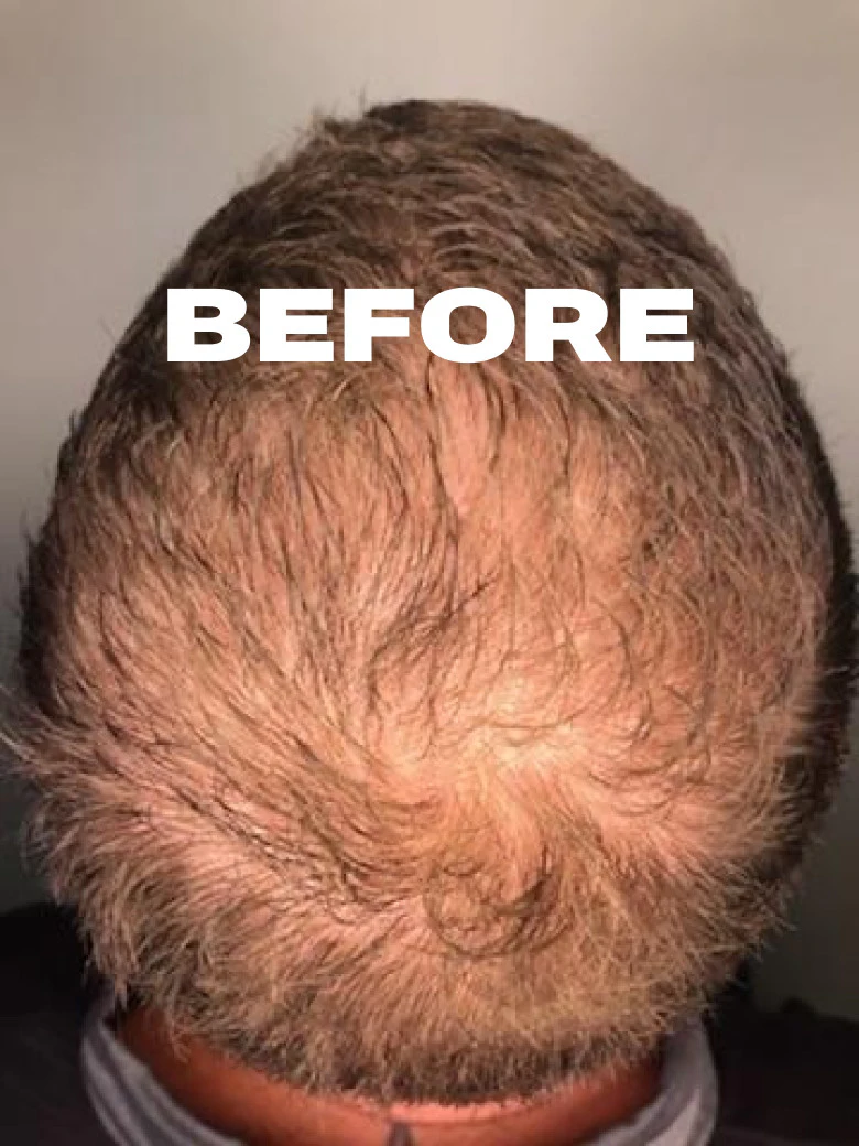 Men with small amount of hair and text 'Before'