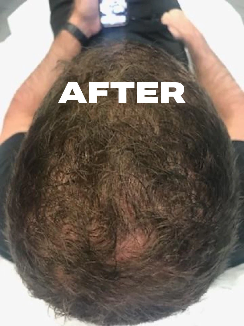 Men with healthy amount of hair and text 'After'